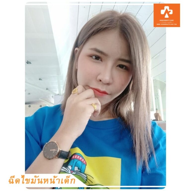อาเซียนบิวตี้คลีนิค Asean Beauty Clinic Review ฉีดไขมันหน้าเด็ก #01