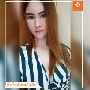 ฉีดไขมันหน้าเด็ก#10