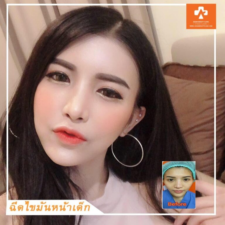 Review ฉีดไขมันหน้าเด็ก #12