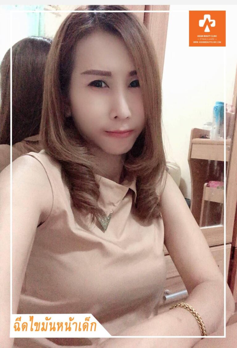 Review ฉีดไขมันหน้าเด็ก #13