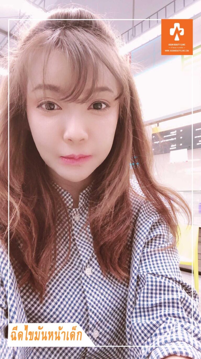 Review ฉีดไขมันหน้าเด็ก #15