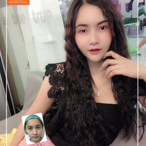 ฉีดไขมันหน้าเด็ก#16