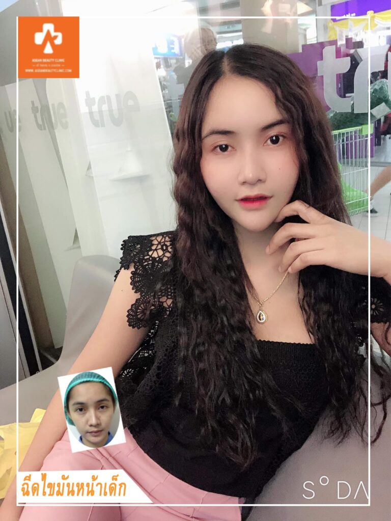 Review ฉีดไขมันหน้าเด็ก #16