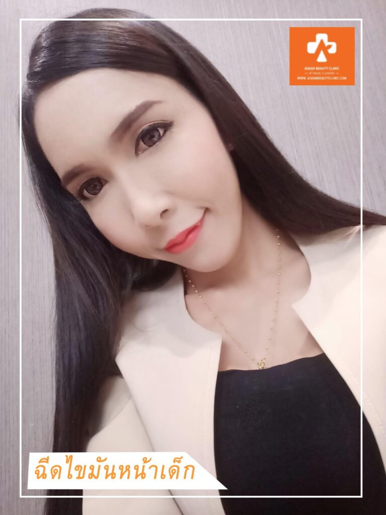 อาเซียนบิวตี้คลีนิค Asean Beauty Clinic Review ฉีดไขมันหน้าเด็ก #19