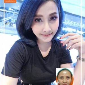 ฉีดไขมันหน้าเด็ก#2