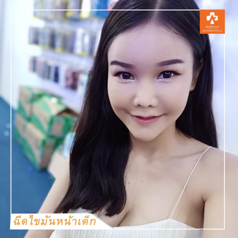 อาเซียนบิวตี้คลีนิค Asean Beauty Clinic Review ฉีดไขมันหน้าเด็ก #21