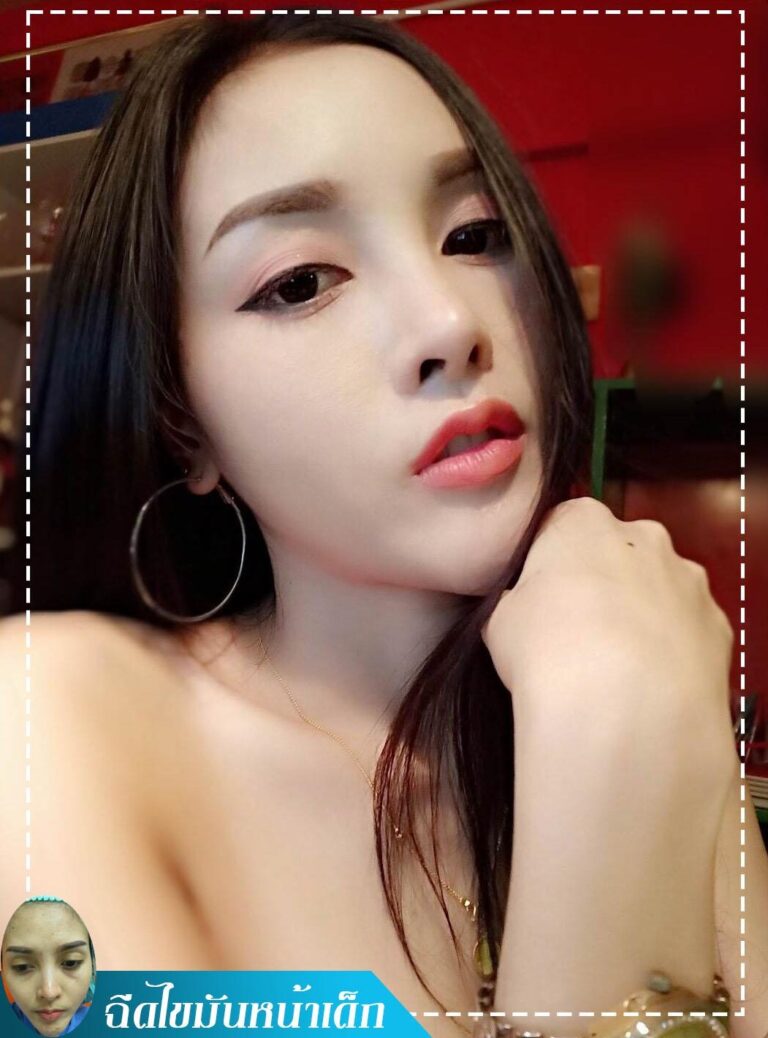 อาเซียนบิวตี้คลีนิค Asean Beauty Clinic Review ฉีดไขมันหน้าเด็ก #22