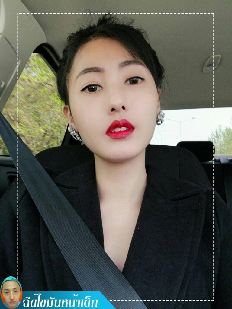 อาเซียนบิวตี้คลีนิค Asean Beauty Clinic Review ฉีดไขมันหน้าเด็ก #23