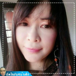 ฉีดไขมันหน้าเด็ก#27