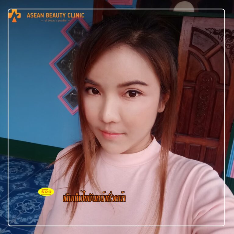 Review ฉีดไขมันหน้าเด็ก #28