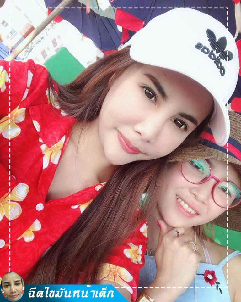 Review ฉีดไขมันหน้าเด็ก #32