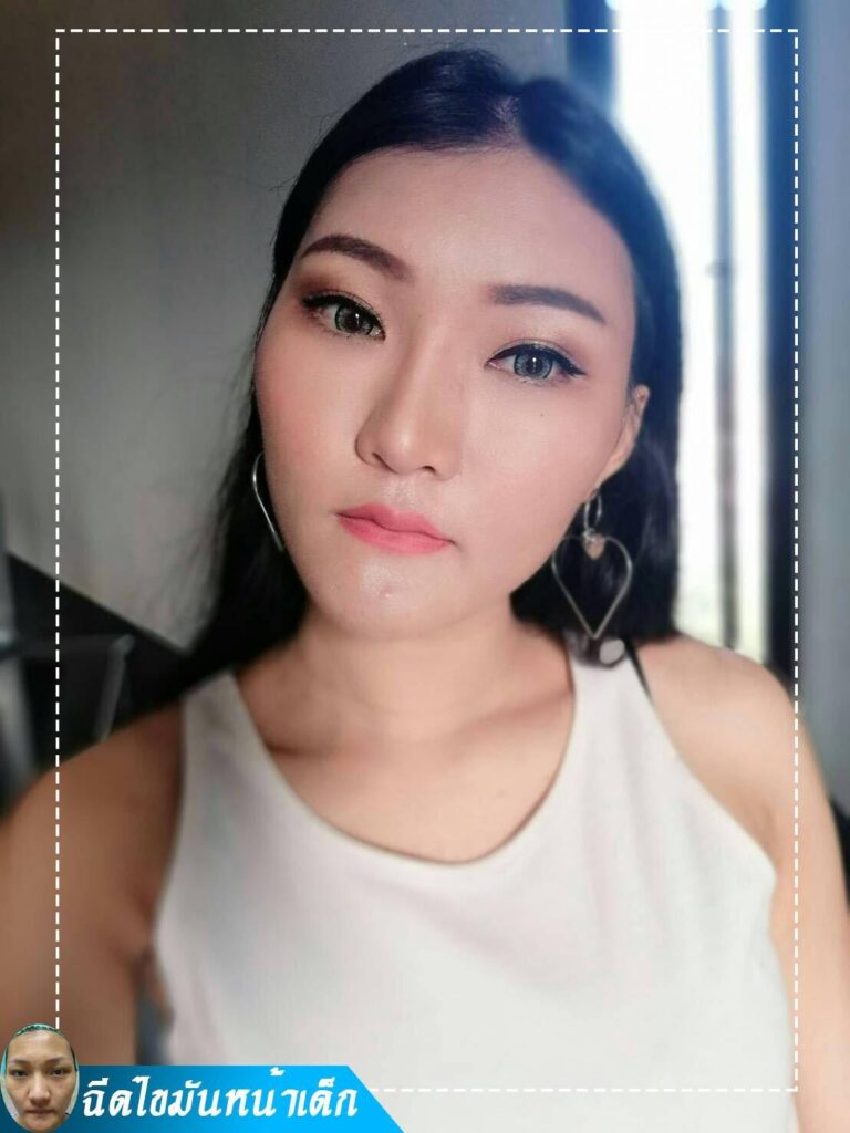 Review ฉีดไขมันหน้าเด็ก #34