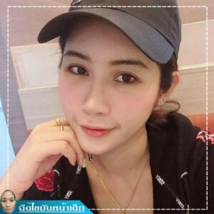 ฉีดไขมันหน้าเด็ก#35