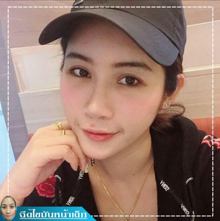 Review ฉีดไขมันหน้าเด็ก #35