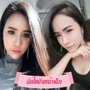 ฉีดไขมันหน้าเด็ก#4