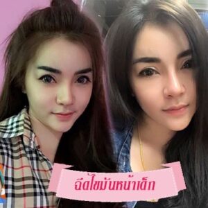 ฉีดไขมันหน้าเด็ก#5