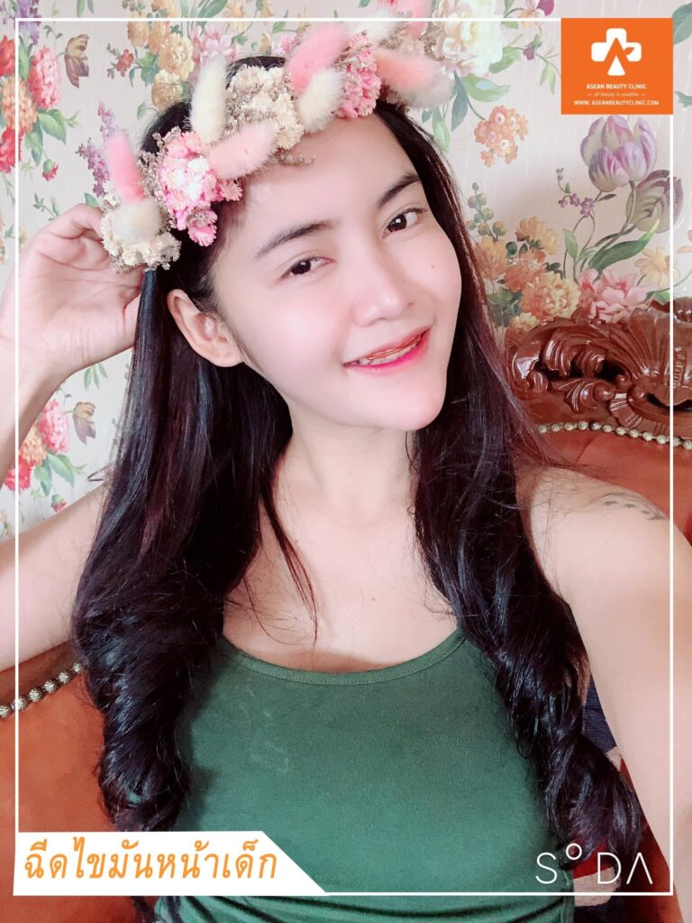 อาเซียนบิวตี้คลีนิค Asean Beauty Clinic Review ฉีดไขมันหน้าเด็ก #06