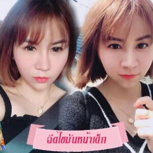 ฉีดไขมันหน้าเด็ก#7