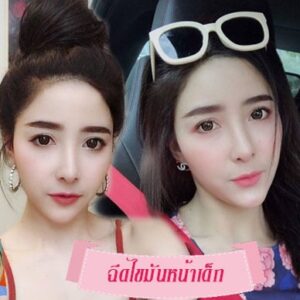 ฉีดไขมันหน้าเด็ก#8