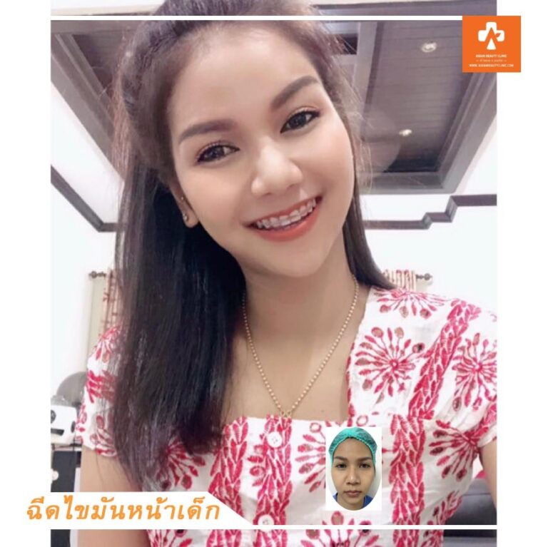 อาเซียนบิวตี้คลีนิค Asean Beauty Clinic Review ฉีดไขมันหน้าเด็ก #09