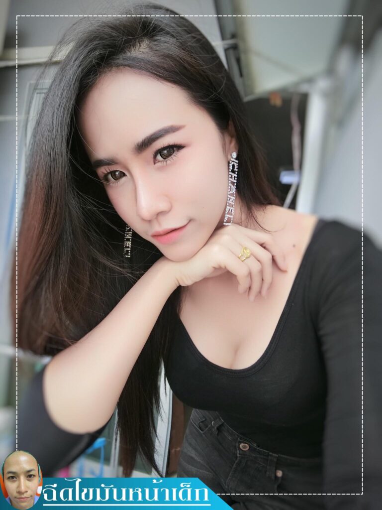 Review ฉีดไขมันหน้าเด็ก #100