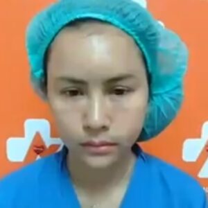 รีวิวฉีดไขมันหน้าเด็ก#29