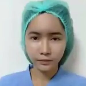 รีวิวฉีดไขมันหน้าเด็ก#30