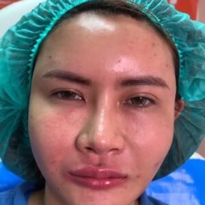 รีวิวฉีดไขมันหน้าเด็ก#36