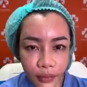 รีวิวฉีดไขมันหน้าเด็ก#37