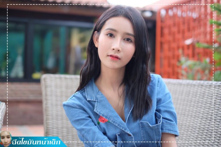 อาเซียนบิวตี้คลีนิค Asean Beauty Clinic Review ฉีดไขมันหน้าเด็ก #40