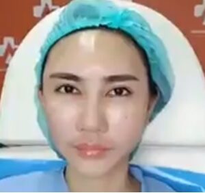 อาเซียนบิวตี้คลีนิค Asean Beauty Clinic รีวิวฉีดไขมันหน้าเด็ก#41