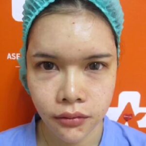 อาเซียนบิวตี้คลีนิค Asean Beauty Clinic รีวิวฉีดไขมันหน้าเด็ก#42