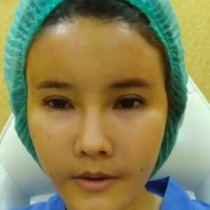 รีวิวฉีดไขมันหน้าเด็ก#43