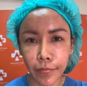 รีวิวฉีดไขมันหน้าเด็ก#44