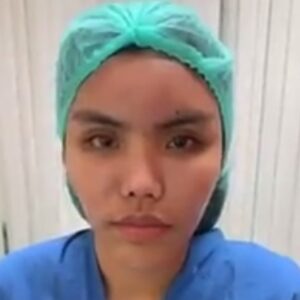 รีวิวฉีดไขมันหน้าเด็ก#45