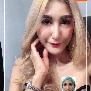 รีวิวฉีดไขมันหน้าเด็ก#47