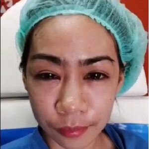 อาเซียนบิวตี้คลีนิค Asean Beauty Clinic รีวิวฉีดไขมันหน้าเด็ก#51