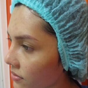 อาเซียนบิวตี้คลีนิค Asean Beauty Clinic รีวิวฉีดไขมันหน้าเด็ก#52