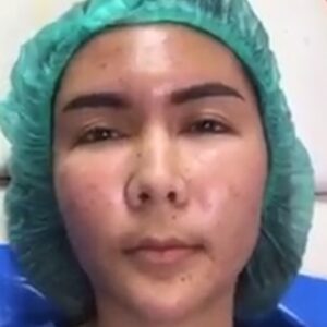 อาเซียนบิวตี้คลีนิค Asean Beauty Clinic รีวิวฉีดไขมันหน้าเด็ก#54