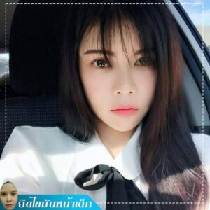 รีวิวฉีดไขมันหน้าเด็ก#59