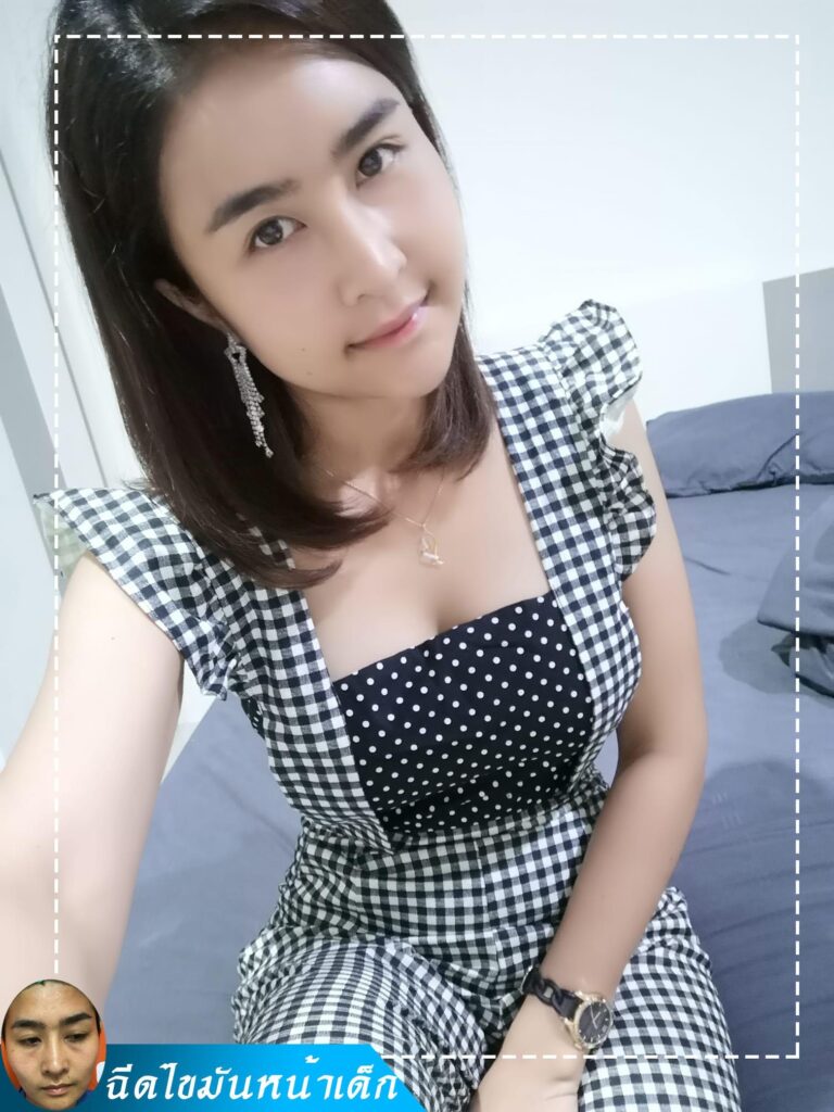 Review ฉีดไขมันหน้าเด็ก #72