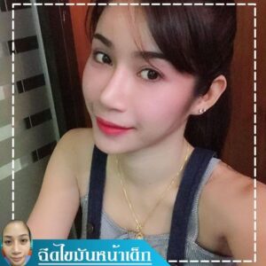 รีวิวฉีดไขมันหน้าเด็ก#74