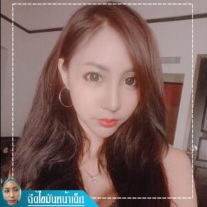 อาเซียนบิวตี้คลีนิค Asean Beauty Clinic รีวิวฉีดไขมันหน้าเด็ก#85