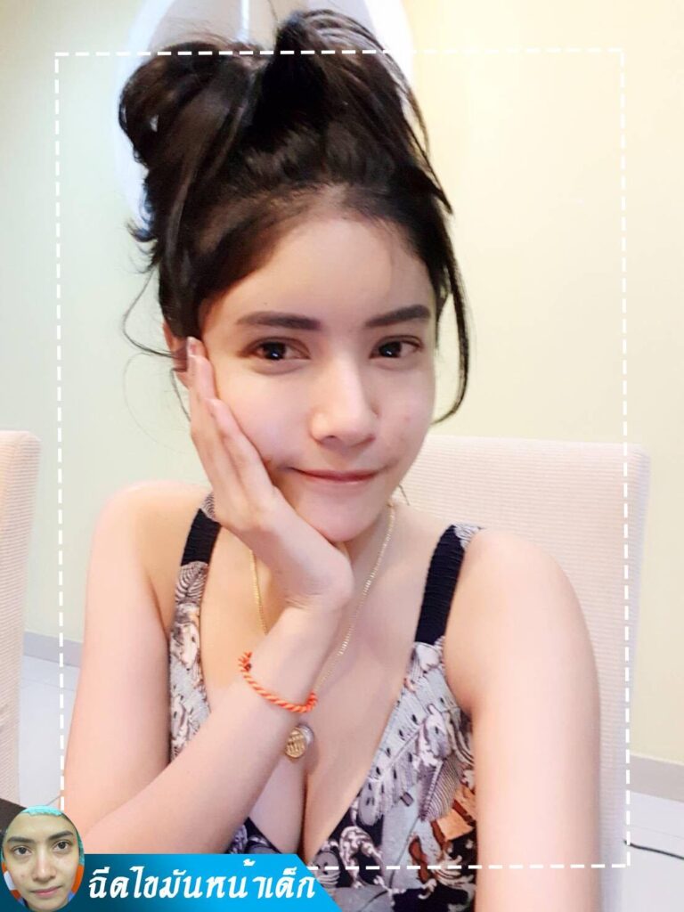 Review ฉีดไขมันหน้าเด็ก #88