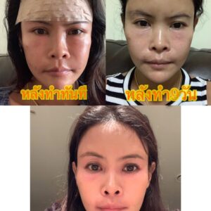 รีวิวฉีดไขมันหน้าเด็ก#89