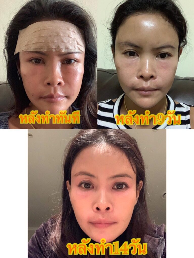 Review ฉีดไขมันหน้าเด็ก #89