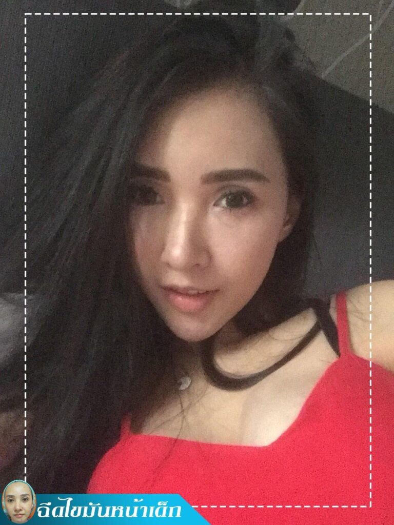 Review ฉีดไขมันหน้าเด็ก #90