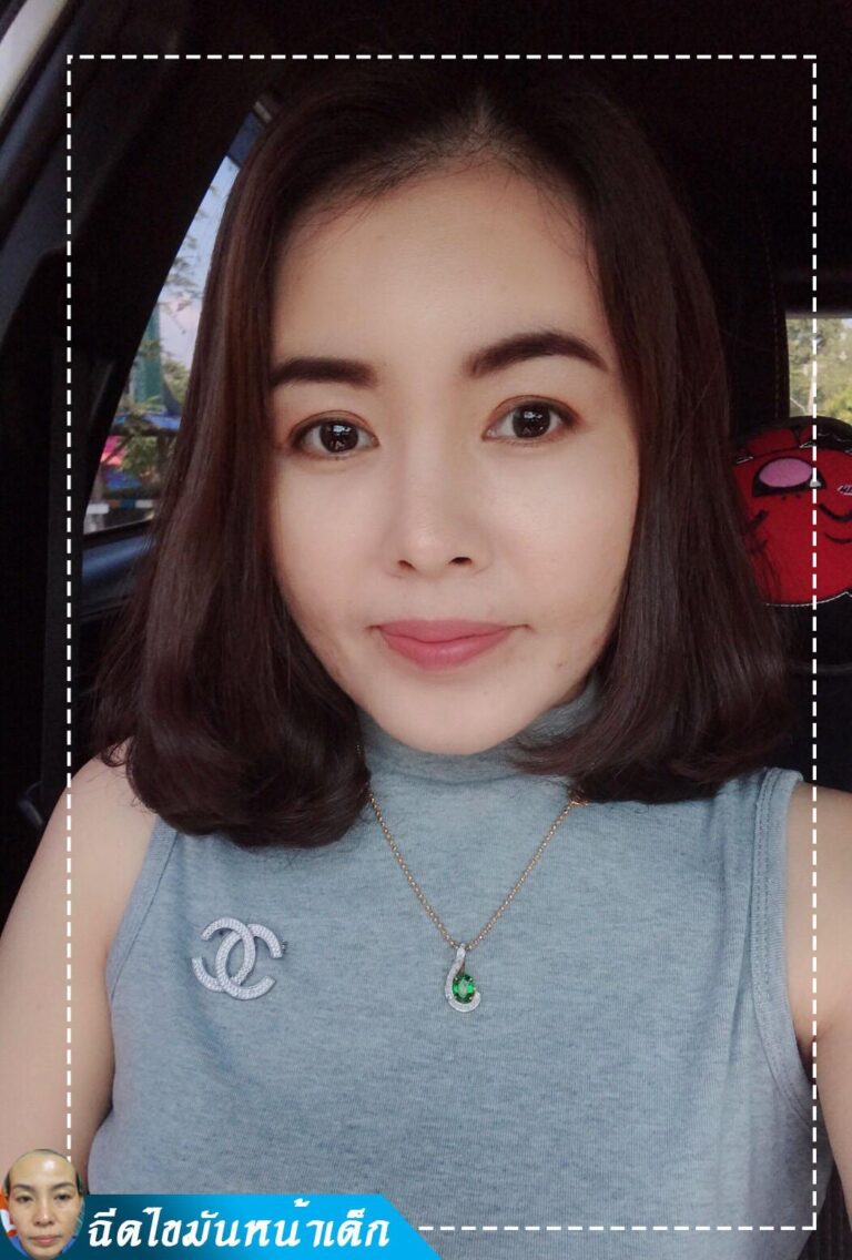 Review ฉีดไขมันหน้าเด็ก #92