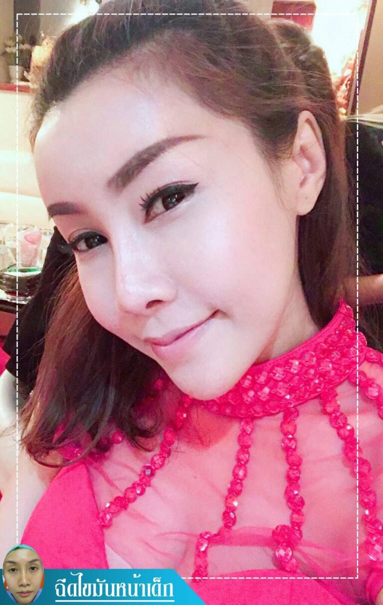 Review ฉีดไขมันหน้าเด็ก #95