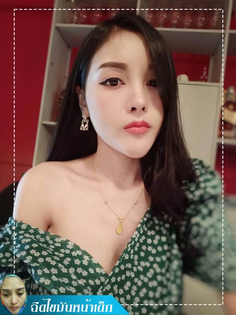 Review ฉีดไขมันหน้าเด็ก #96